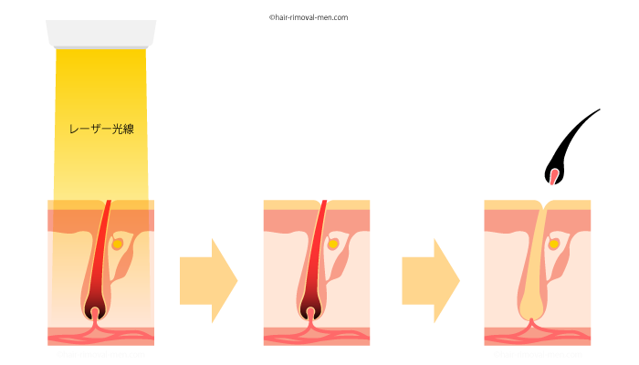 医療脱毛の原理